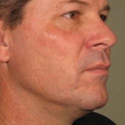 Ultherapy Face Before & After Patient #21208