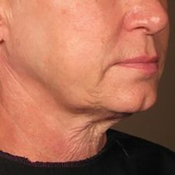 Ultherapy Face Before & After Patient #21210