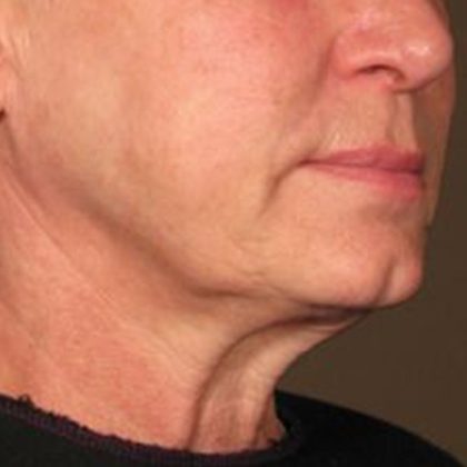 Ultherapy Face Before & After Patient #21210