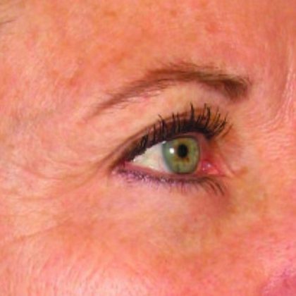Ultherapy Face Before & After Patient #21211