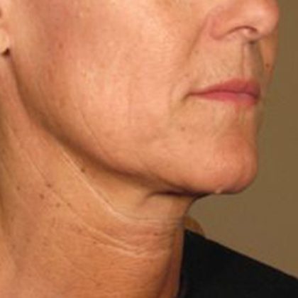 Ultherapy Face Before & After Patient #21212