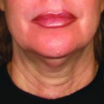 Ultherapy Face Before & After Patient #21217