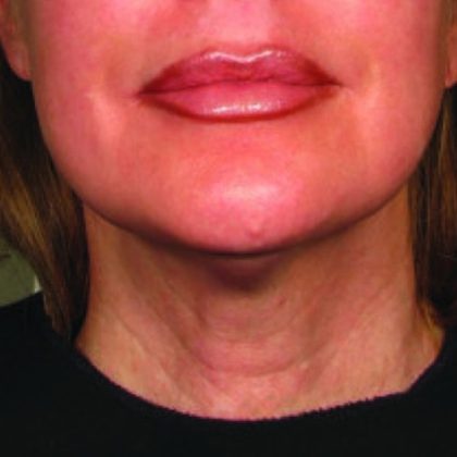 Ultherapy Face Before & After Patient #21217
