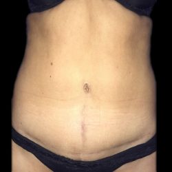 Tummy Tuck Before & After Patient #21258