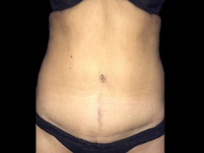 Tummy Tuck Before & After Patient #21258