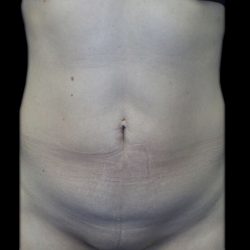 Tummy Tuck Before & After Patient #21258