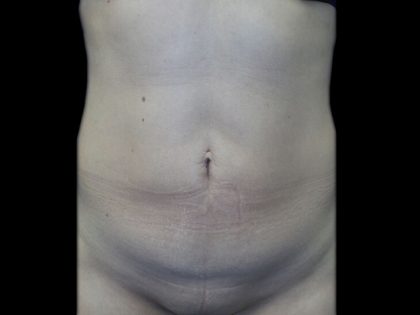 Tummy Tuck Before & After Patient #21258