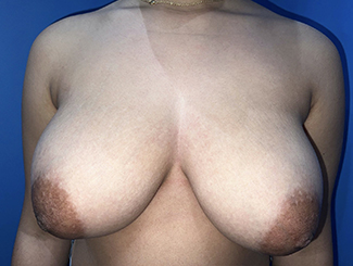 Breast Reduction Before & After Patient #22178