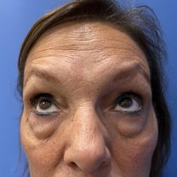 Blepharoplasty Before & After Patient #21939