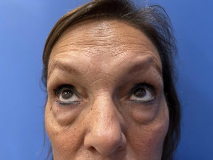 Blepharoplasty Before & After Patient #21939