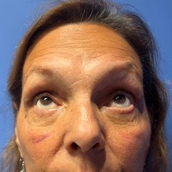 Blepharoplasty Before & After Patient #21939