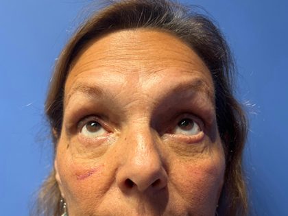 Blepharoplasty Before & After Patient #21939