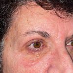 Blepharoplasty Before & After Patient #21940