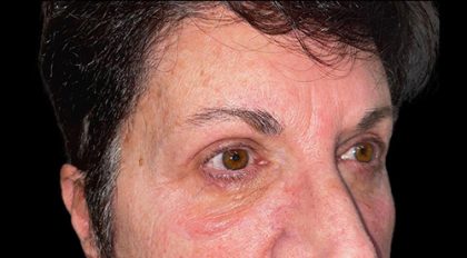 Blepharoplasty Before & After Patient #21940