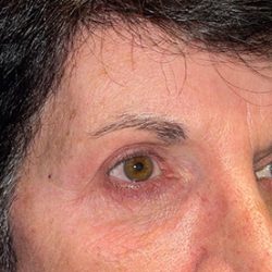 Blepharoplasty Before & After Patient #21940