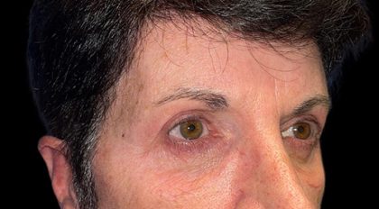 Blepharoplasty Before & After Patient #21940