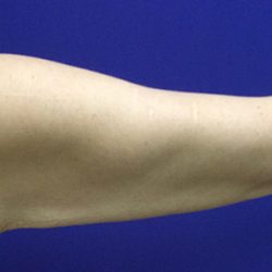 Arm Lift Before & After Patient #21962