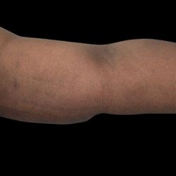 Arm Lift Before & After Patient #21938