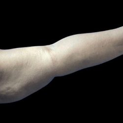 Arm Lift Before & After Patient #21938