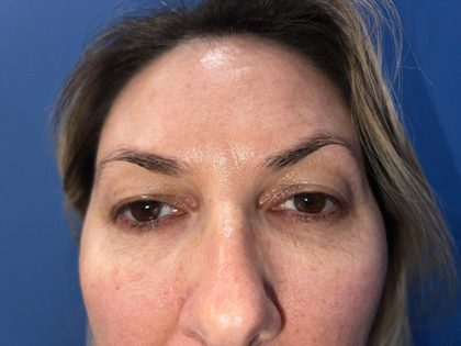 Blepharoplasty Before & After Patient #21942