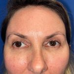 Blepharoplasty Before & After Patient #21942