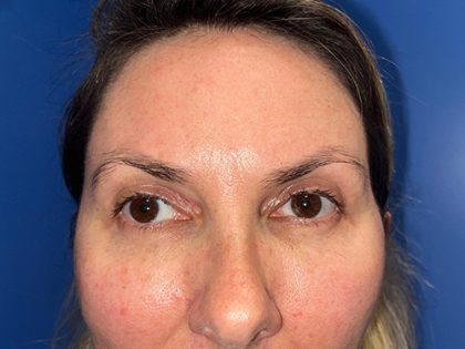 Blepharoplasty Before & After Patient #21942