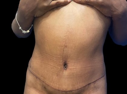 Tummy Tuck Before & After Patient #21963