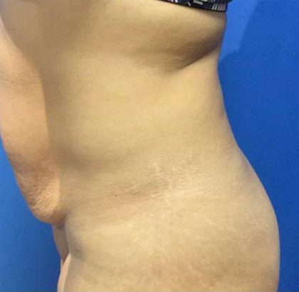 Tummy Tuck Before & After Patient #21955