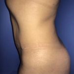 Tummy Tuck Before & After Patient #21955