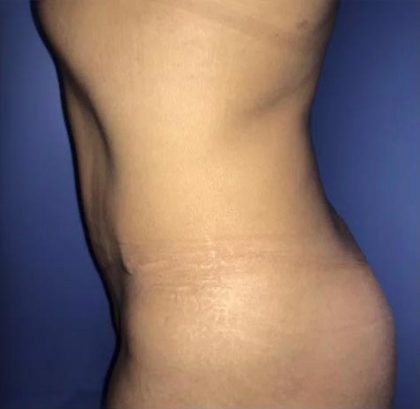 Tummy Tuck Before & After Patient #21955
