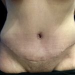 Tummy Tuck Before & After Patient #19233