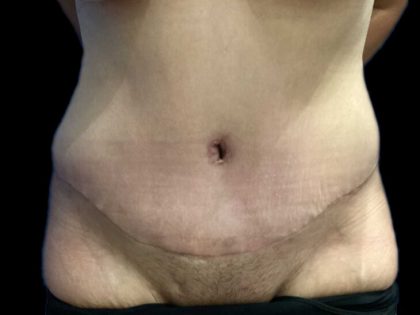 Tummy Tuck Before & After Patient #19233