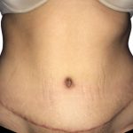 Tummy Tuck Before & After Patient #21278