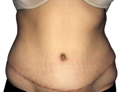 Tummy Tuck Before & After Patient #21278