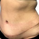 Tummy Tuck Before & After Patient #21278