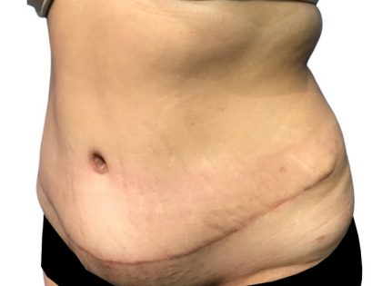 Tummy Tuck Before & After Patient #21278