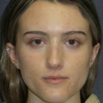 Rhinoplasty Before & After Patient #23556