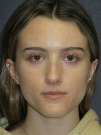 Rhinoplasty Before & After Patient #23556