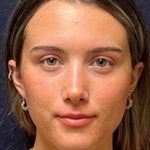 Rhinoplasty Before & After Patient #23556