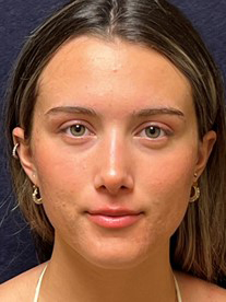 Rhinoplasty Before & After Patient #23556