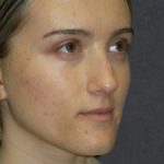 Rhinoplasty Before & After Patient #23556