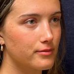 Rhinoplasty Before & After Patient #23556