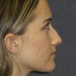 Rhinoplasty Before & After Patient #23556