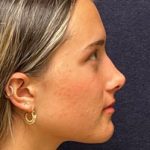 Rhinoplasty Before & After Patient #23556
